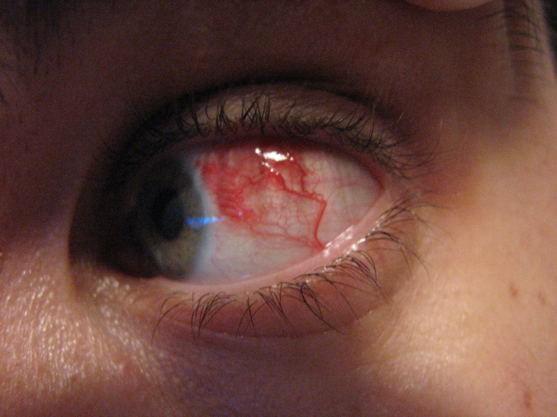 Инсульт глаза