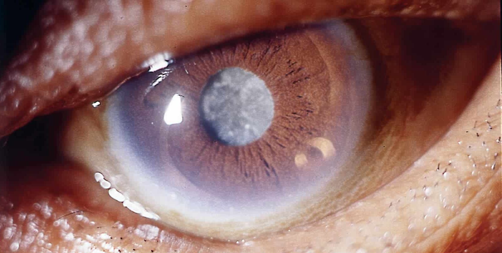 Капли от катаракты - какие лучше выбрать