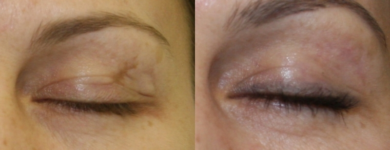 Эффективность лазерной шлифовки век