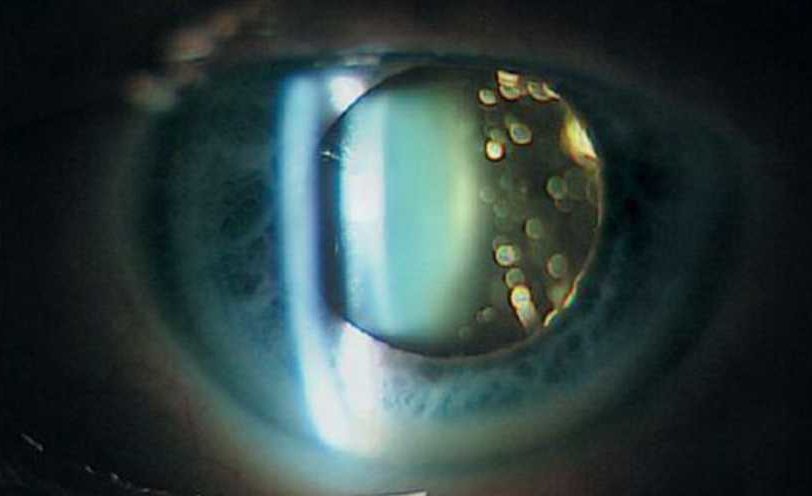 Деструкция стекловидного тела глаза