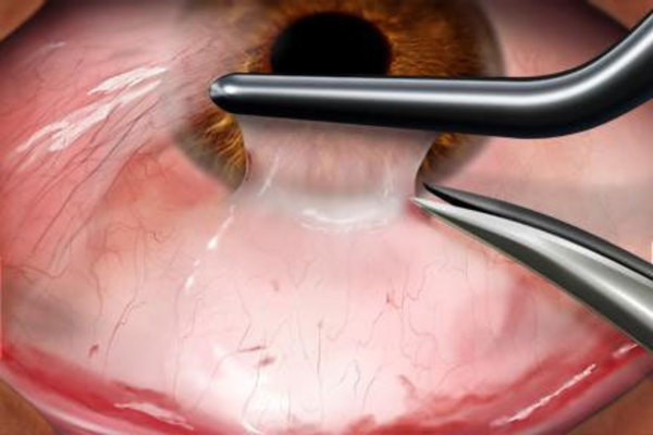 Что такое птеригиум