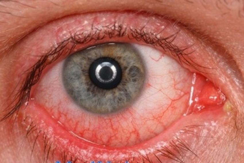 Фотоофтальмия или световая офтальмия