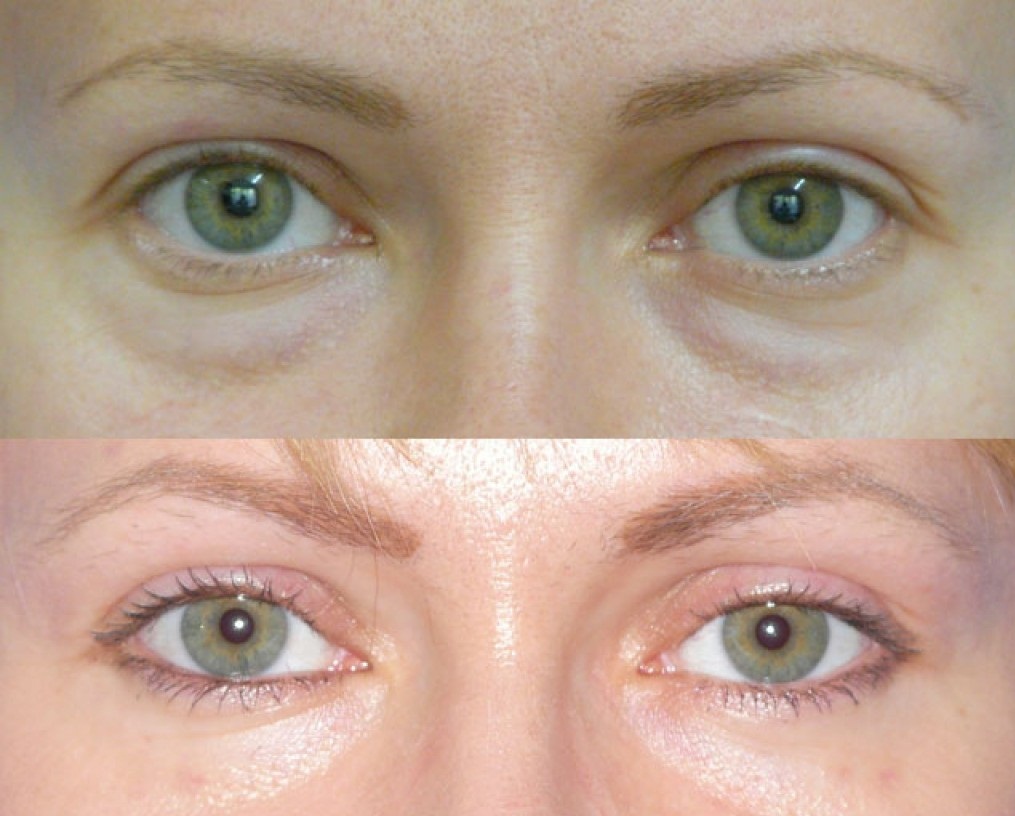 Подтяжка 3D-мезонитями