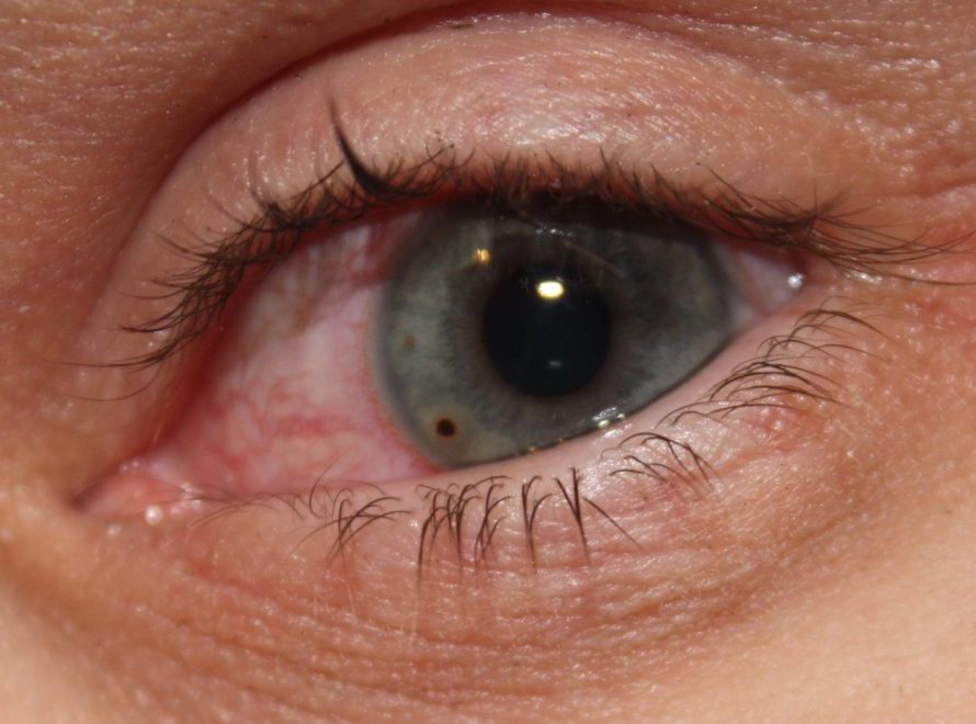 Что делать, если в глаз попала соринка