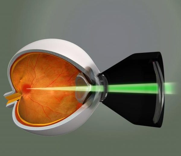 Лазерная коагуляция сетчатки глаза при беременности