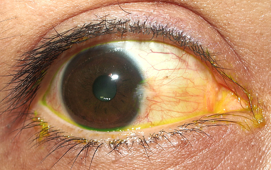 Что такое птеригиум