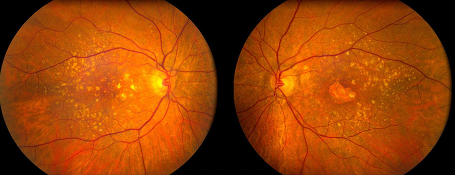 Возрастная макулярная дегенерация