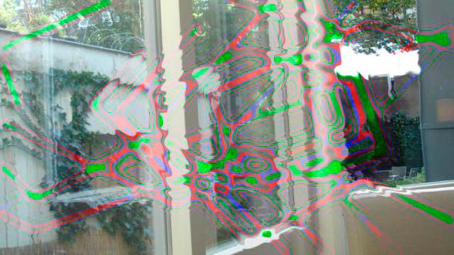 Глазная мигрень или мерцательная скотома