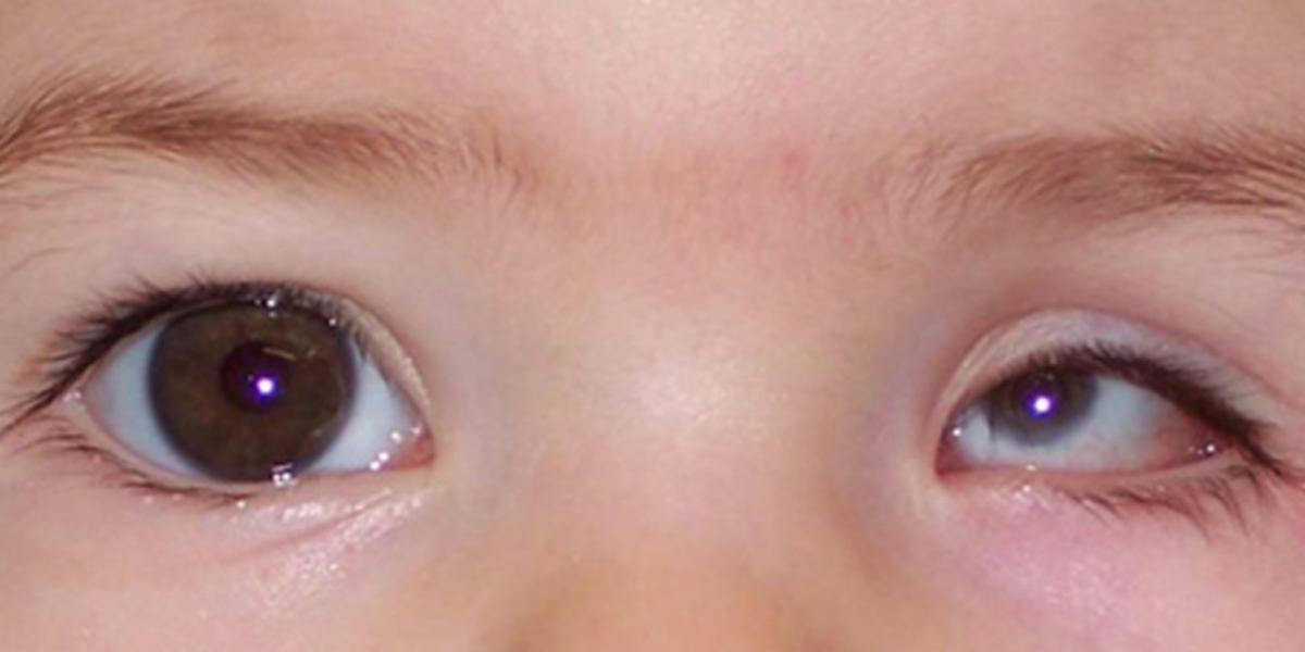 Что такое микрофтальм