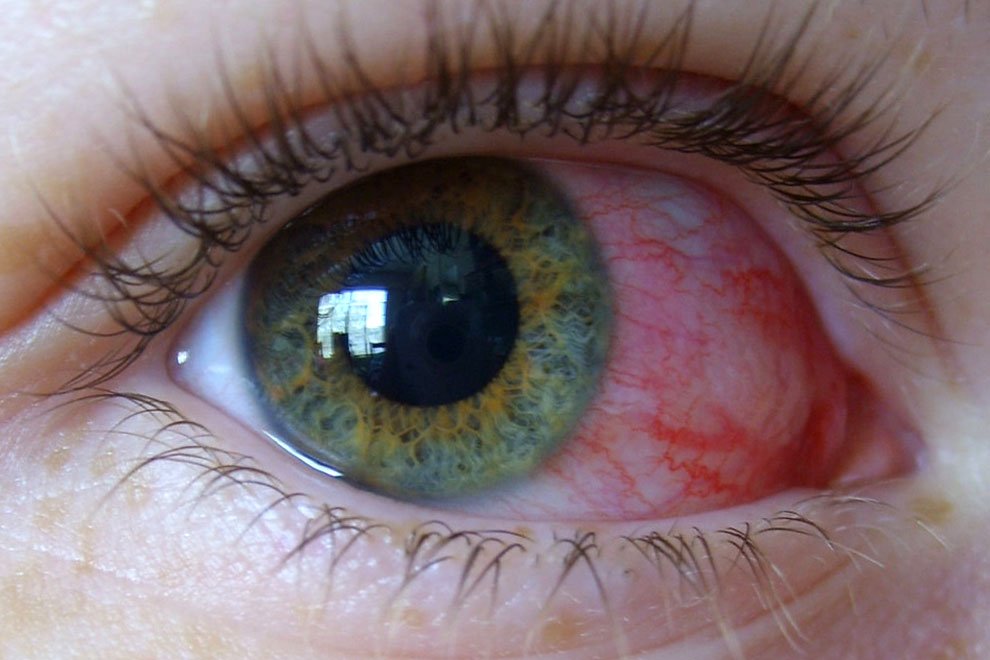 Как лечить кровоизлияние в глазу