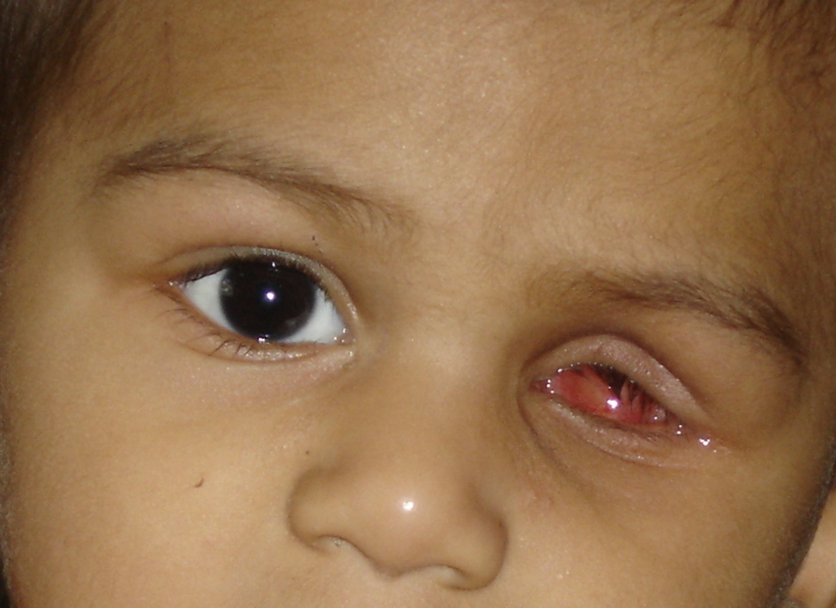 Анофтальм или отсутствие глазного яблока