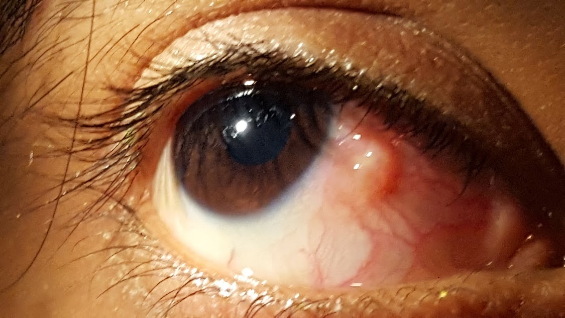 Желтое пятно на белке глаза