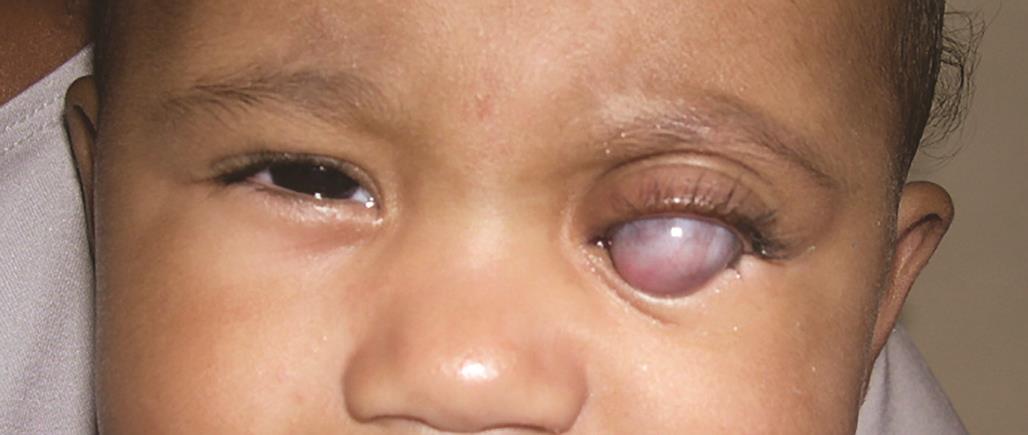 Миопический конус и стафилома