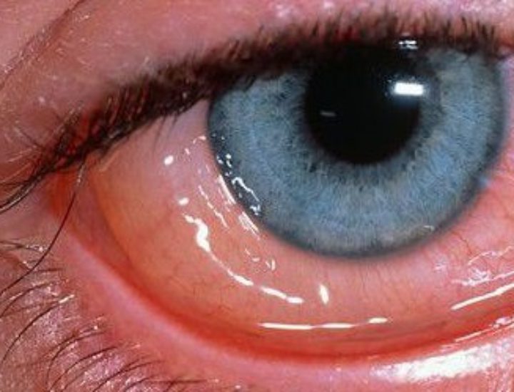 конъюнктивит