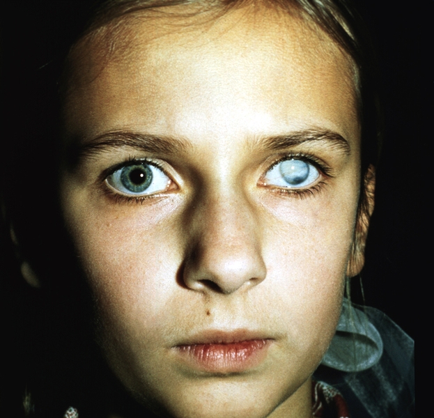 Дают ли инвалидность при слепоте на один глаз