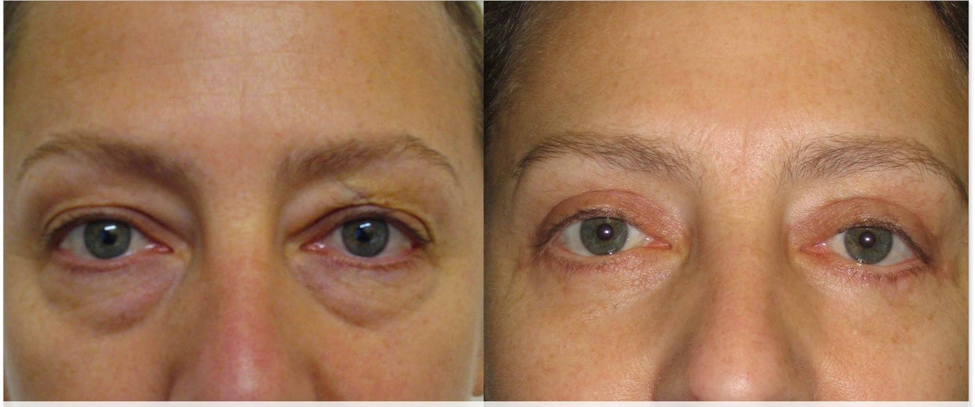 Принцип действия мезотерапии