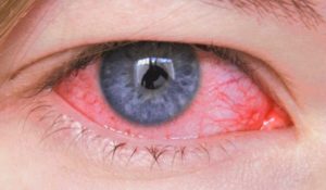 Аденовирусный