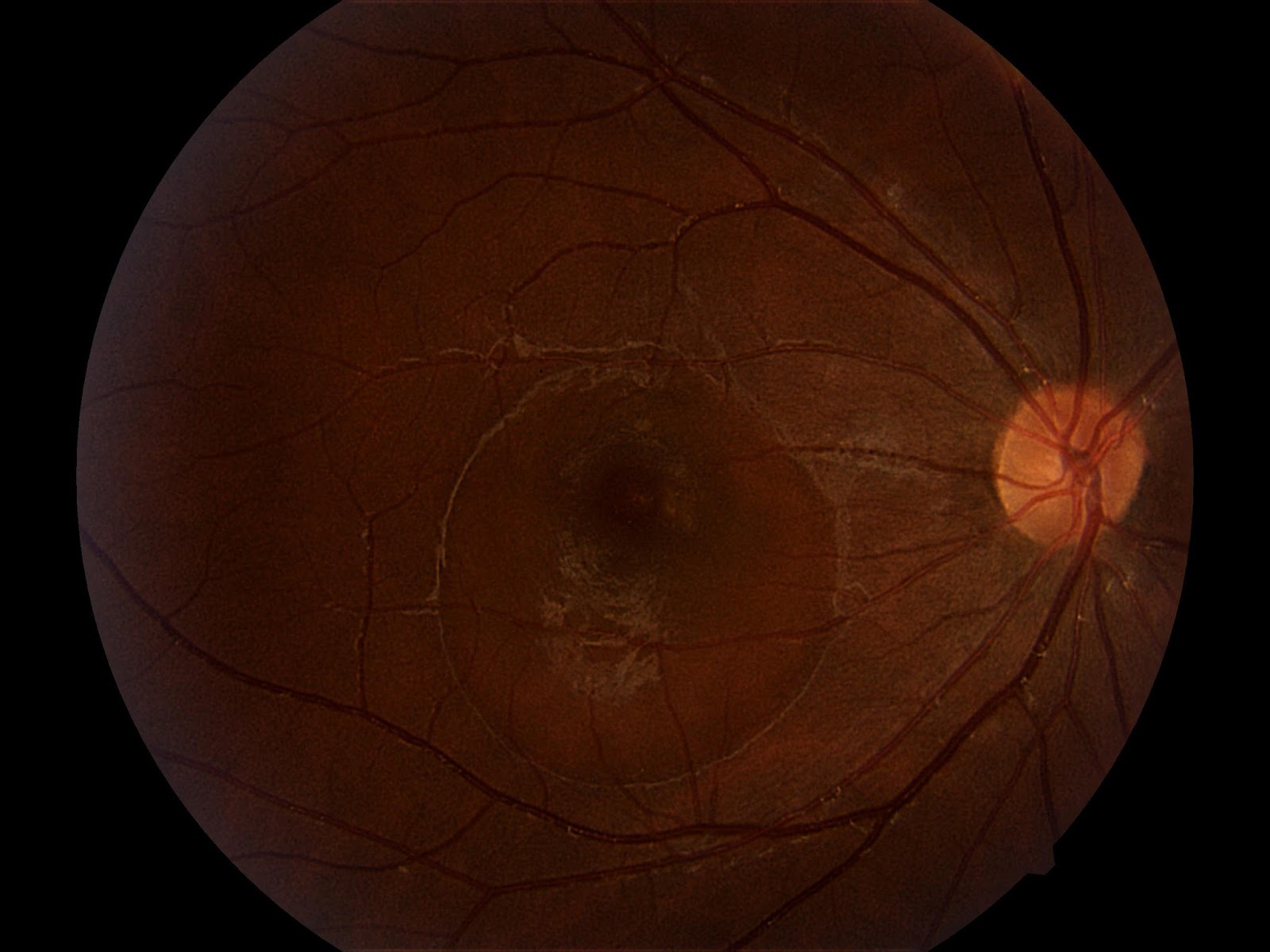 Что такое ретинопатия