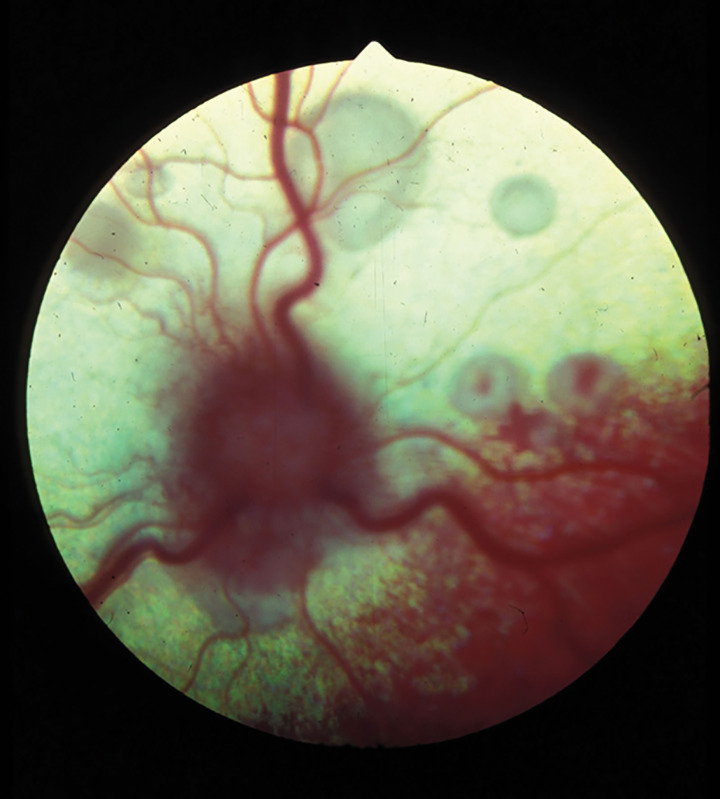 Хориоретинит