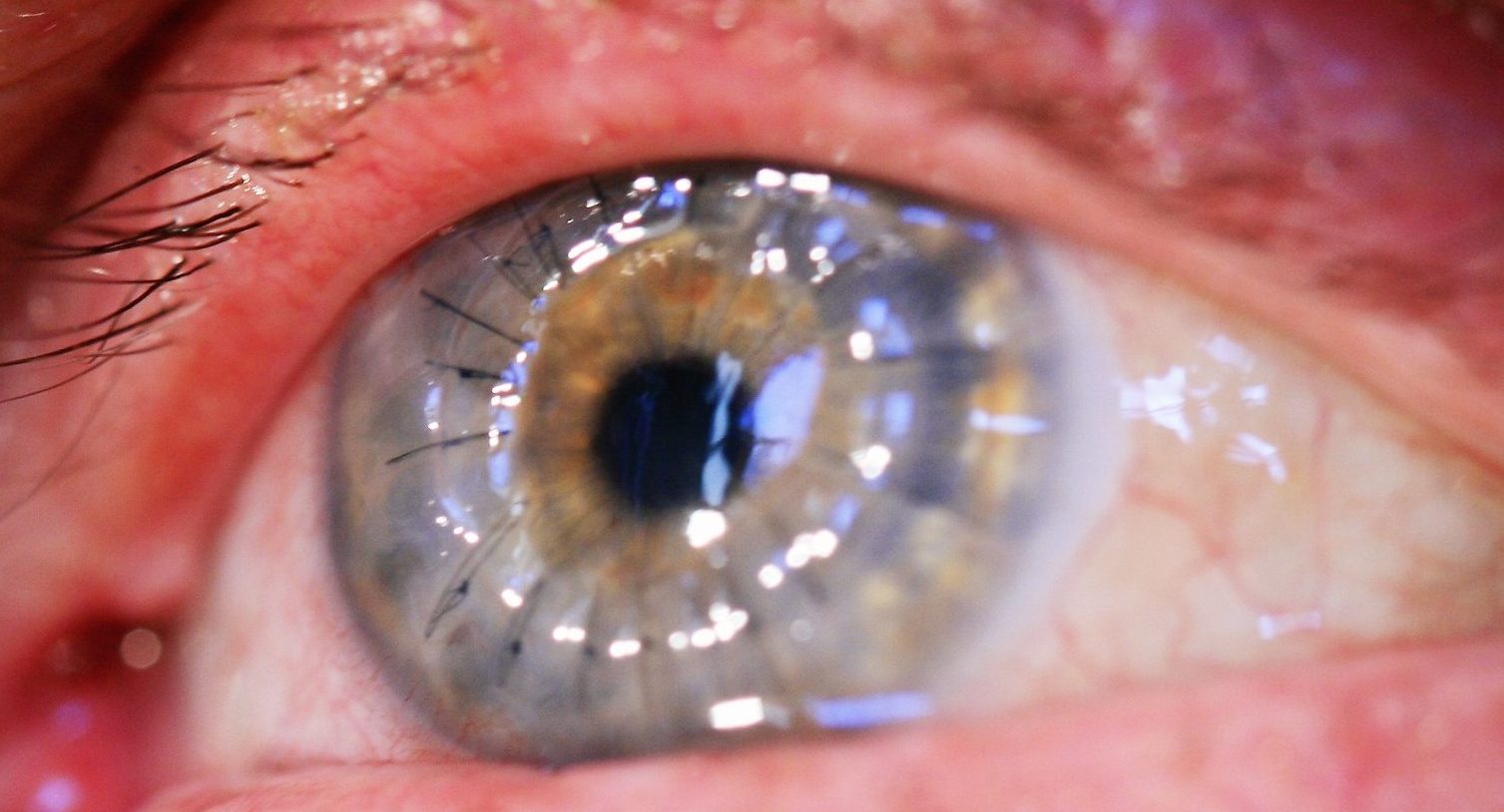 Роговица глаза