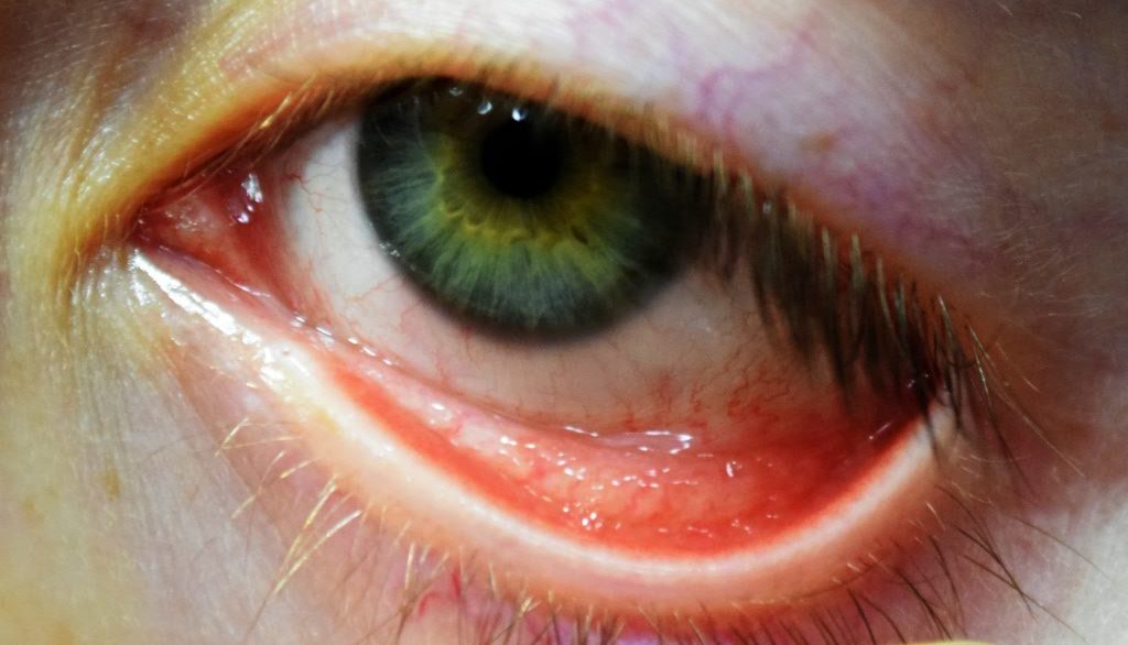 Причины возникновения глазного герпеса