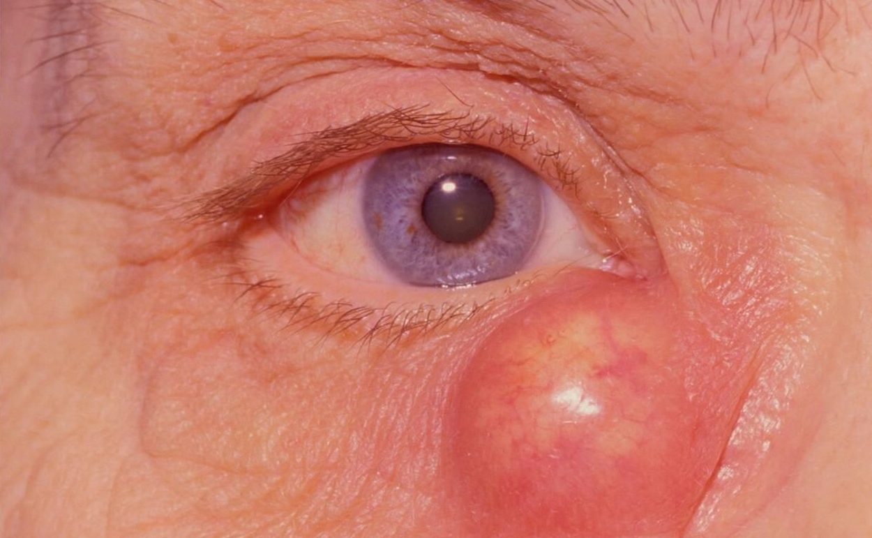 Что делать при воспалении глаз