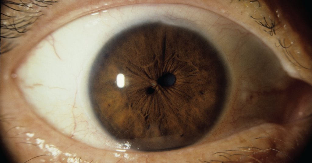 Двойной зрачок или поликория