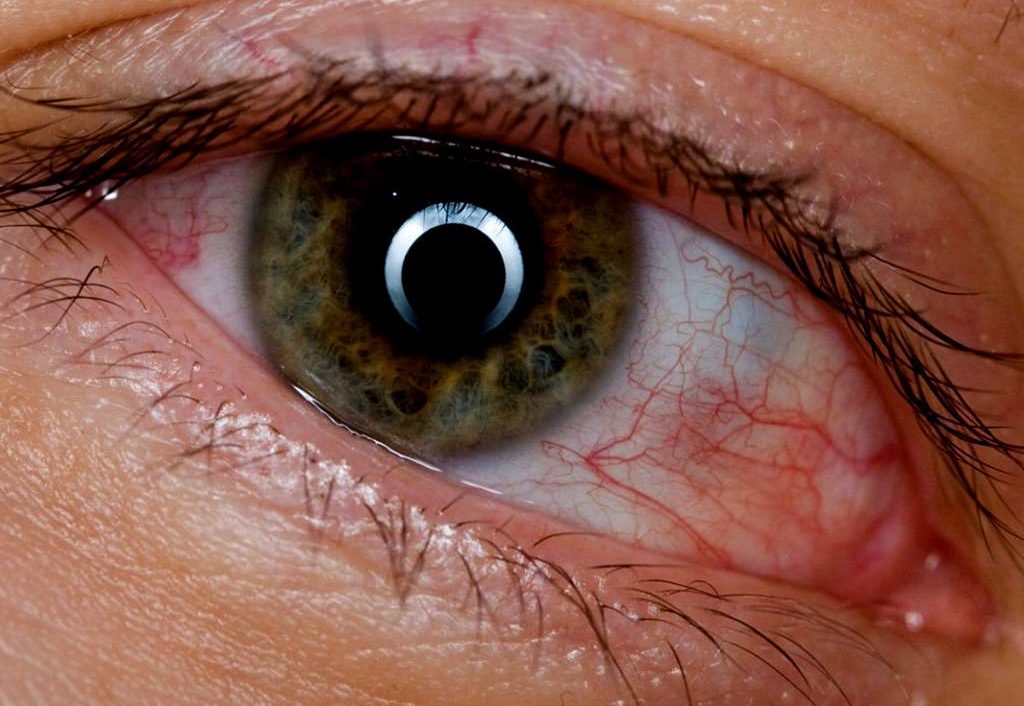 конъюнктивит