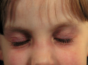 Герпетический дерматит