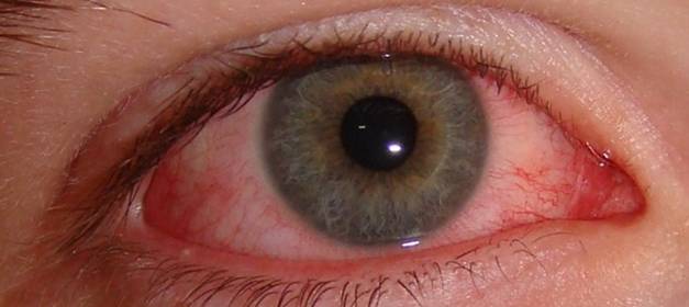 Что такое электроофтальмия