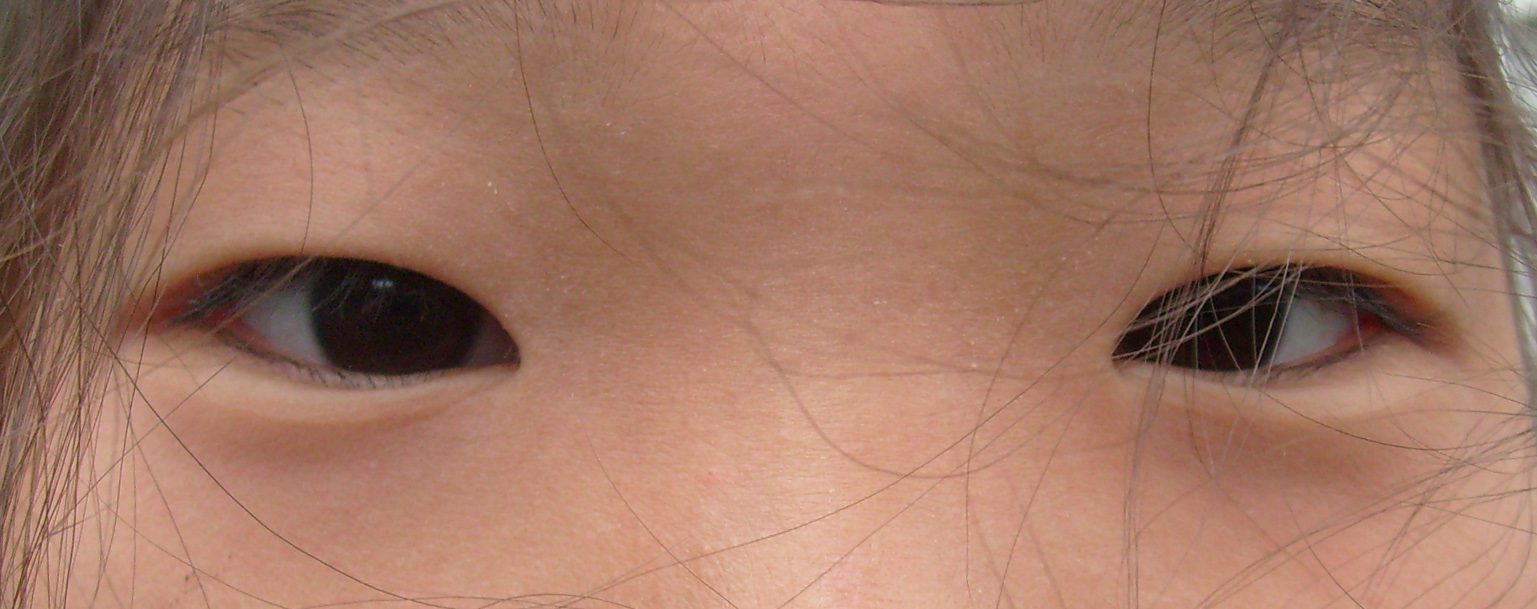 Эпикантус у детей