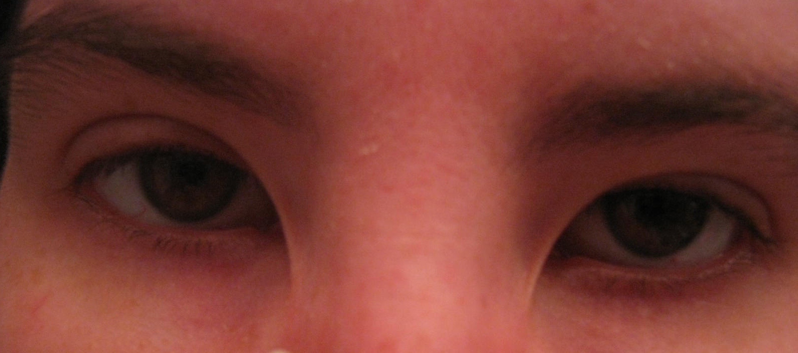 Эпикантус у детей