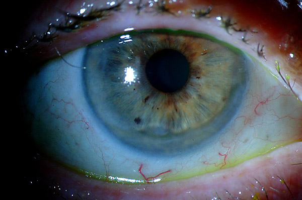 Эрозия роговицы глаза