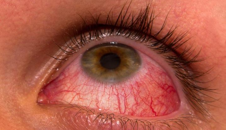 чешутся глаза