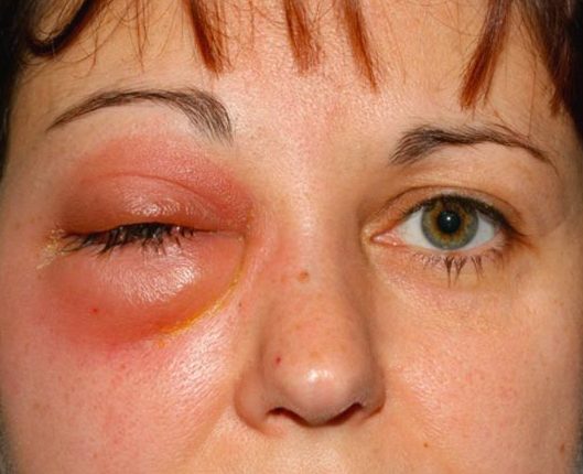 Что такое флегмона глазницы