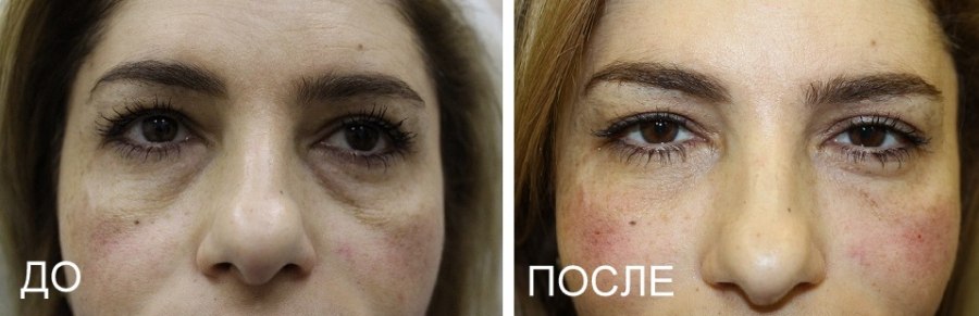 Как убрать слезную борозду под глазами