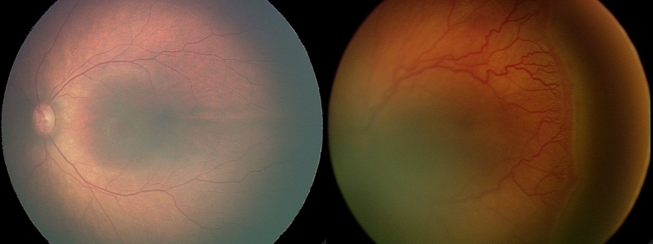 Ретинопатия недоношенных