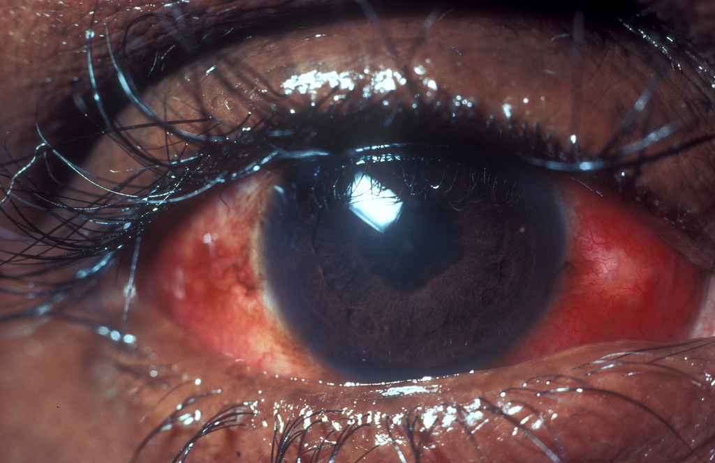 Иридоциклит