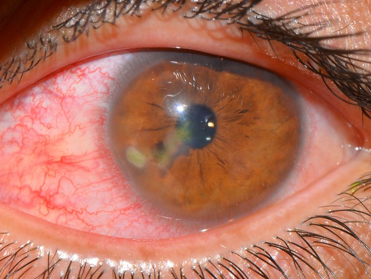 Ксероз роговицы глаза