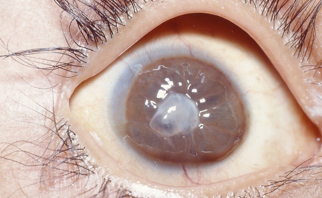 Список заболеваний глаз у человека - описание симптомов