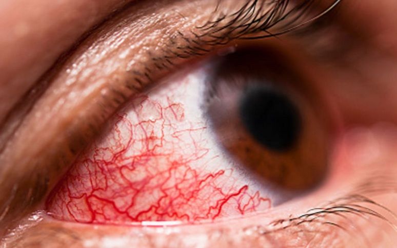 Хронический конъюнктивит