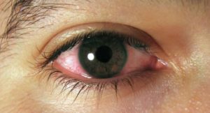 Острый и подострый конъюнктивит