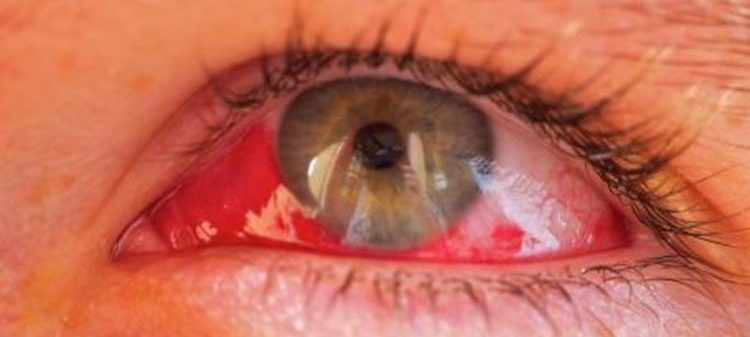 Гемофтальм