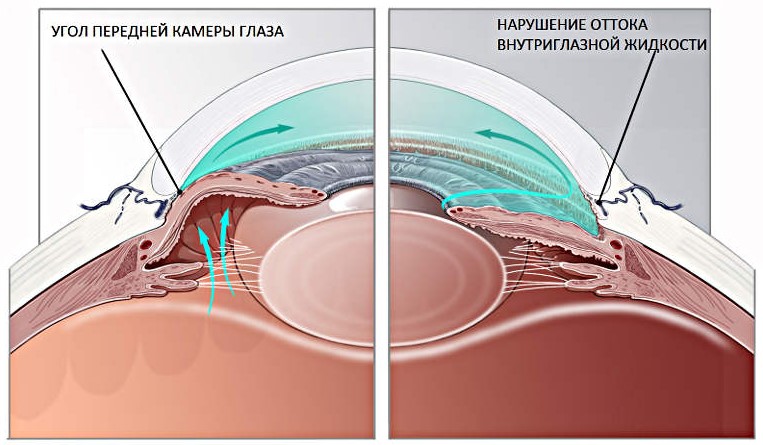 Подготовка к лазерной десцеметогониопунктуре