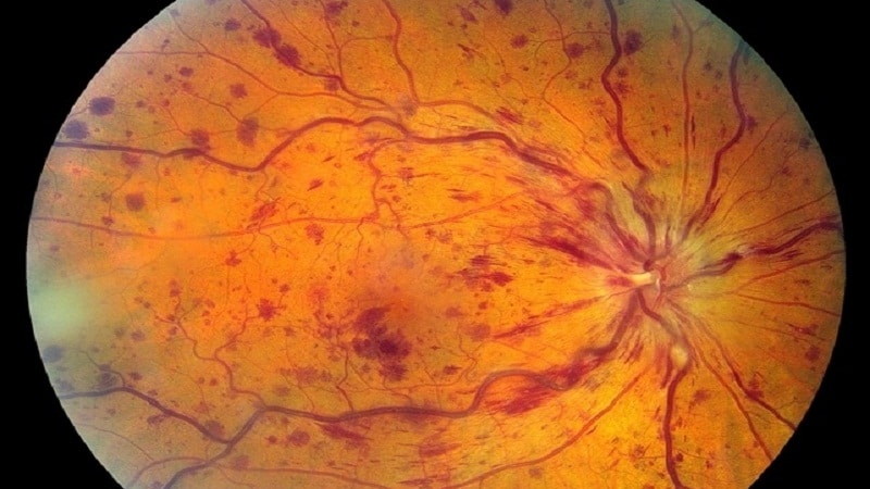 Тромбоз центральной вены сетчатки глаза