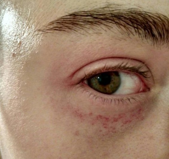 Как избавиться от вен под глазами