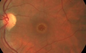 Макулярный разрыв сетчатки