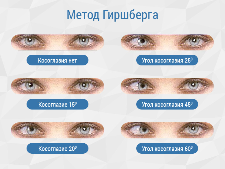 Определение косоглазия методом Гиршберга
