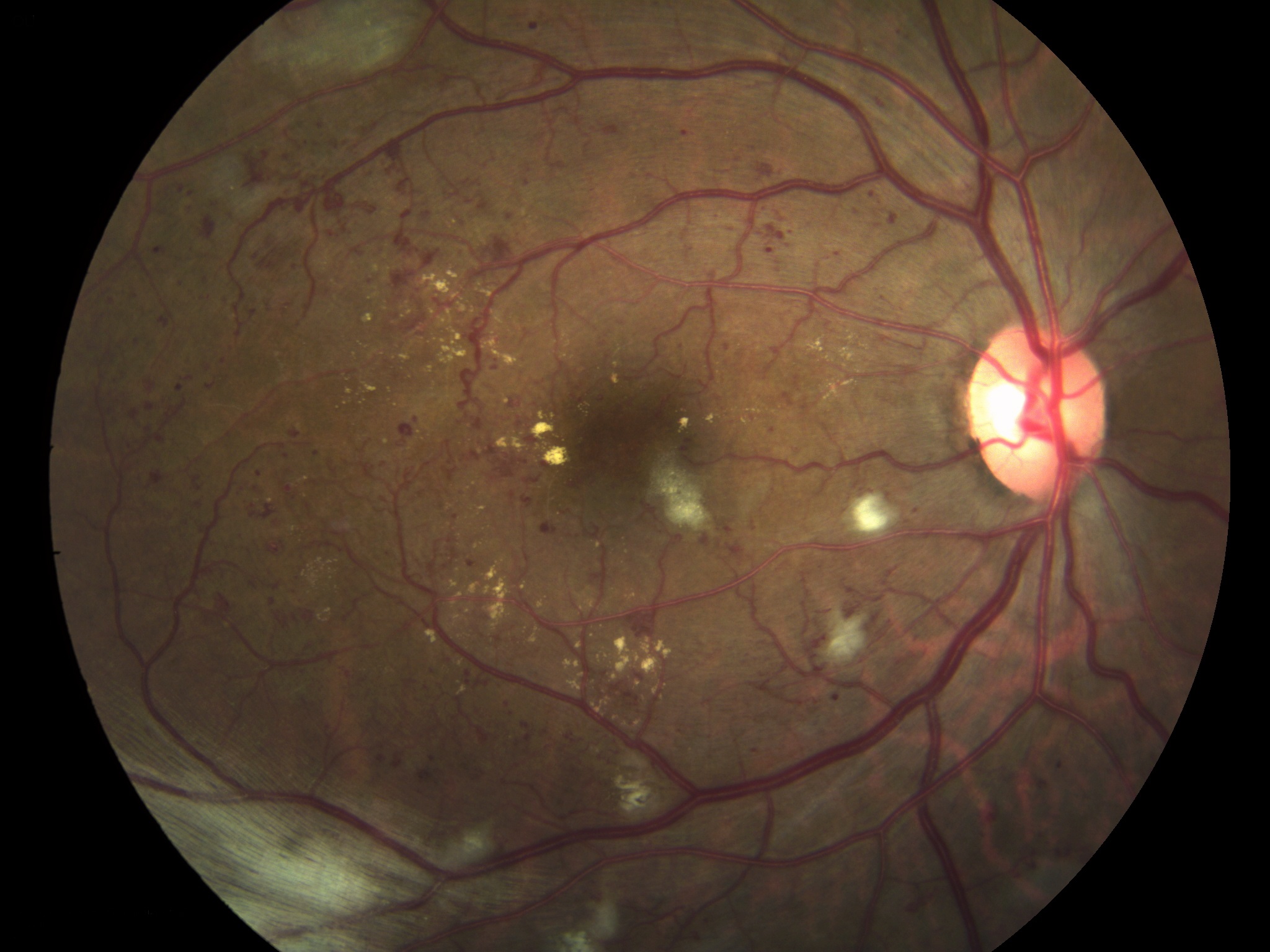 Что такое фоновая ретинопатия у детей и взрослых