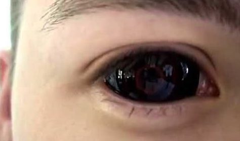 О склеральных линзах